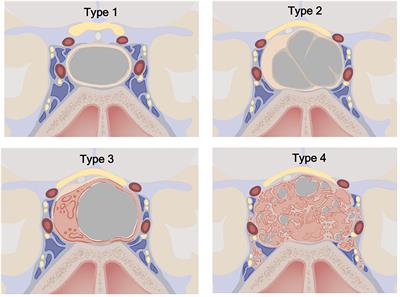 Cyst Type Differentiates Rathke Cleft Cysts From Cystic Pituitary Adenomas